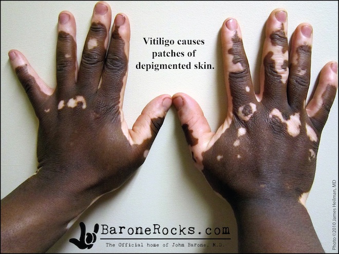 Vitiligo2