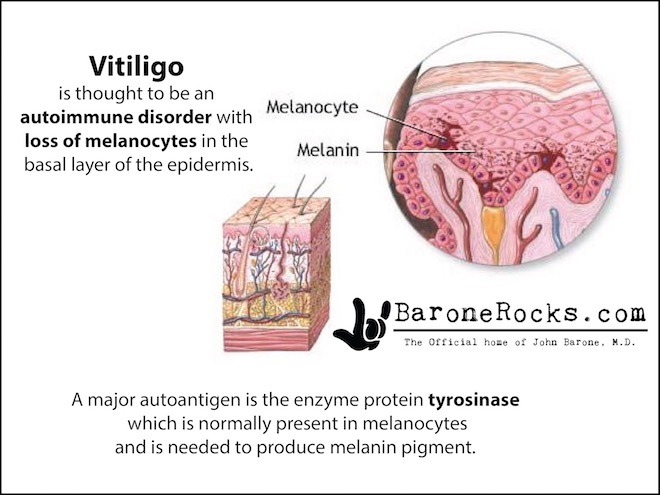 Vitiligo3