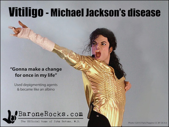 Vitiligo10