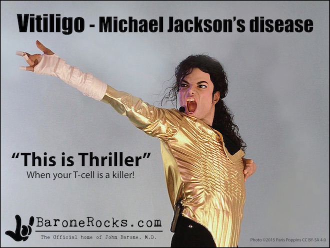 Vitiligo5