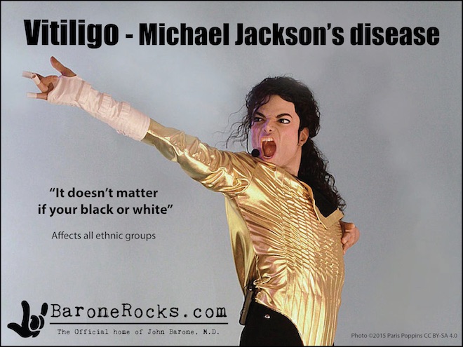 Vitiligo6